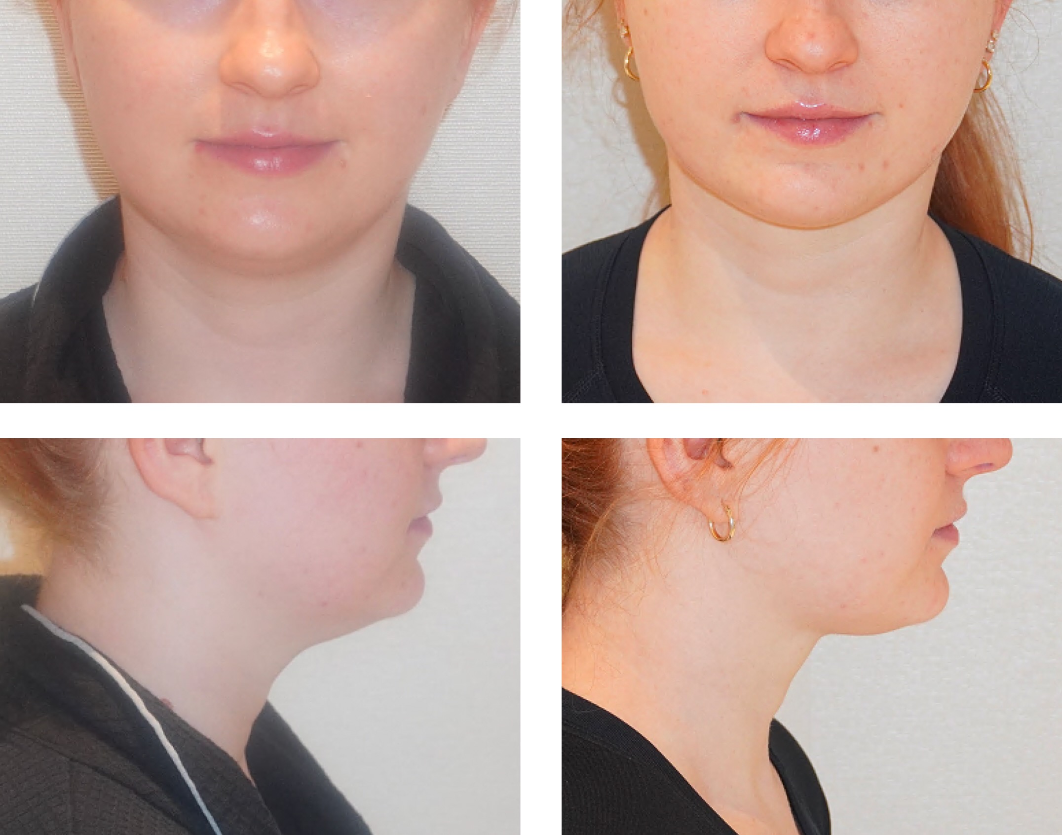 Four before and after photos showing a person's lower face and neck from the front and side, with noticeable changes in jawline and chin between the two sets of Chin Liposuction photos.