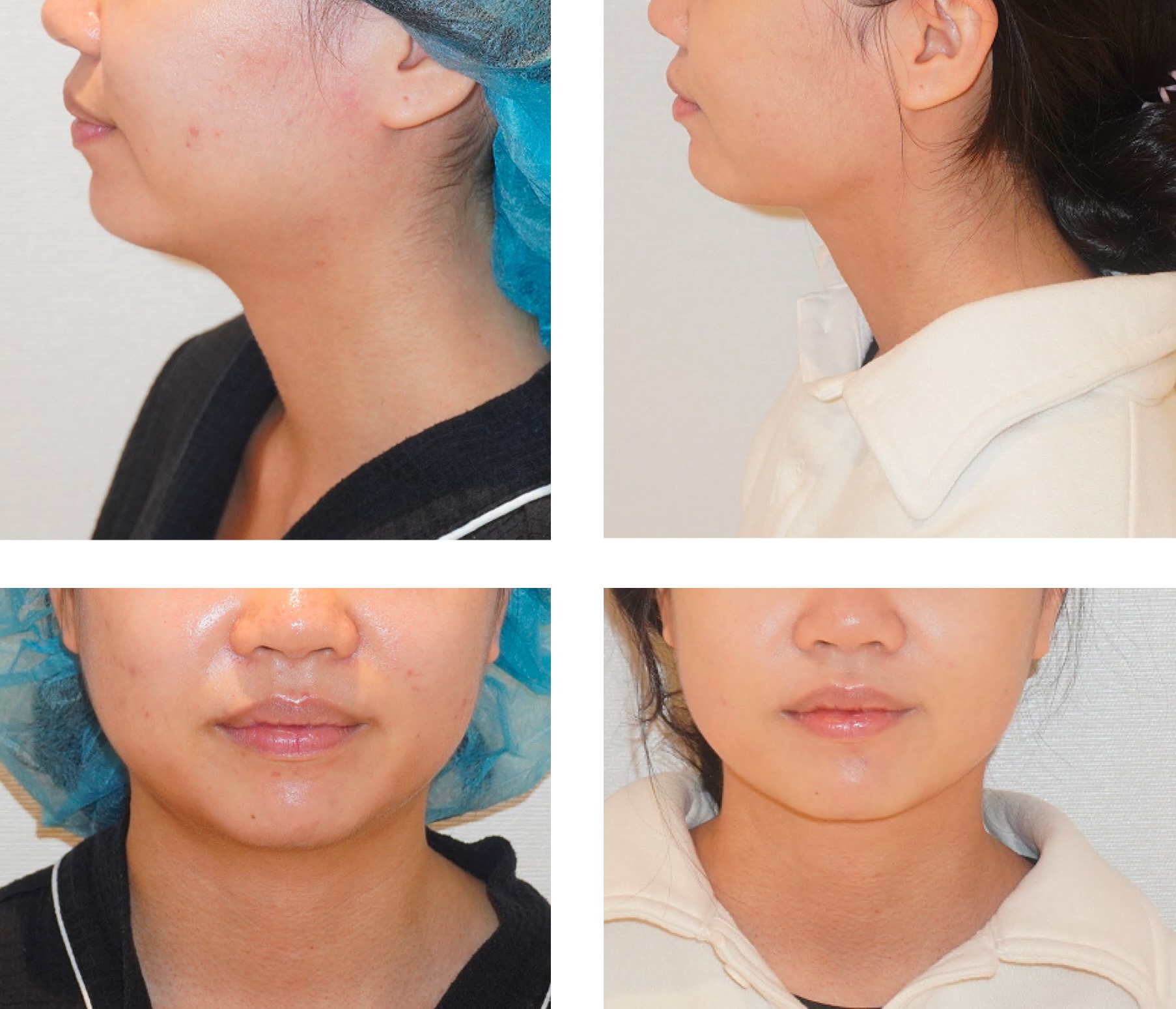 Side-by-side before and after photos of a woman's lower face and neck highlight noticeable skin and contour changes. The right images showcase impressive Chin Liposuction results following the cosmetic procedure.