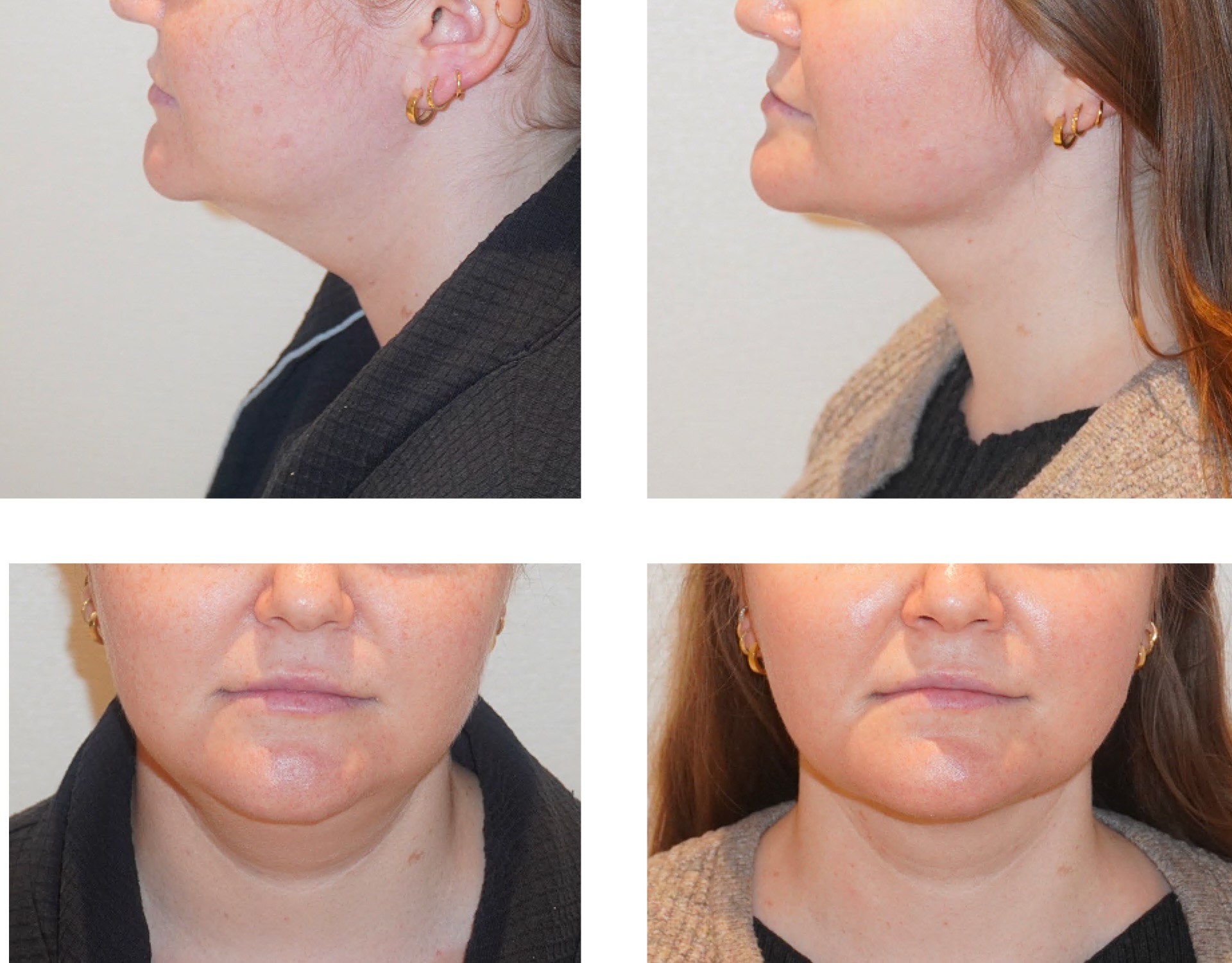 Four photos showing a woman’s chin and jawline from side and front angles, highlighting the visible reduction in submental fullness after Chin Liposuction.