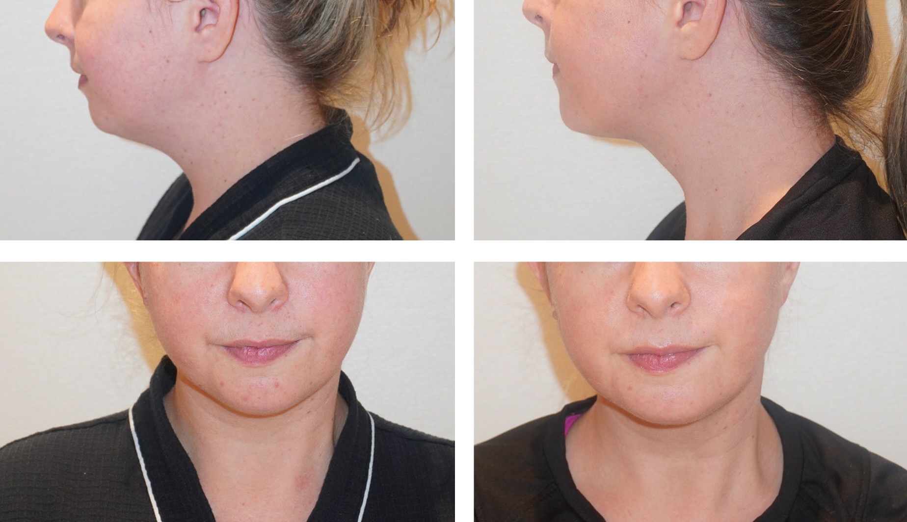 Four Chin Liposuction Before and After Photos showing side and front views of a woman's face and neck, highlighting the visible reduction in submental fullness after treatment.