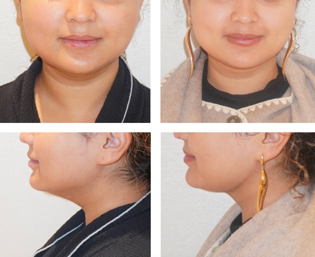 Four Chin Liposuction Photos showing a woman’s face before (left) and after (right) the cosmetic procedure, with different jewelry and outfits in each set.