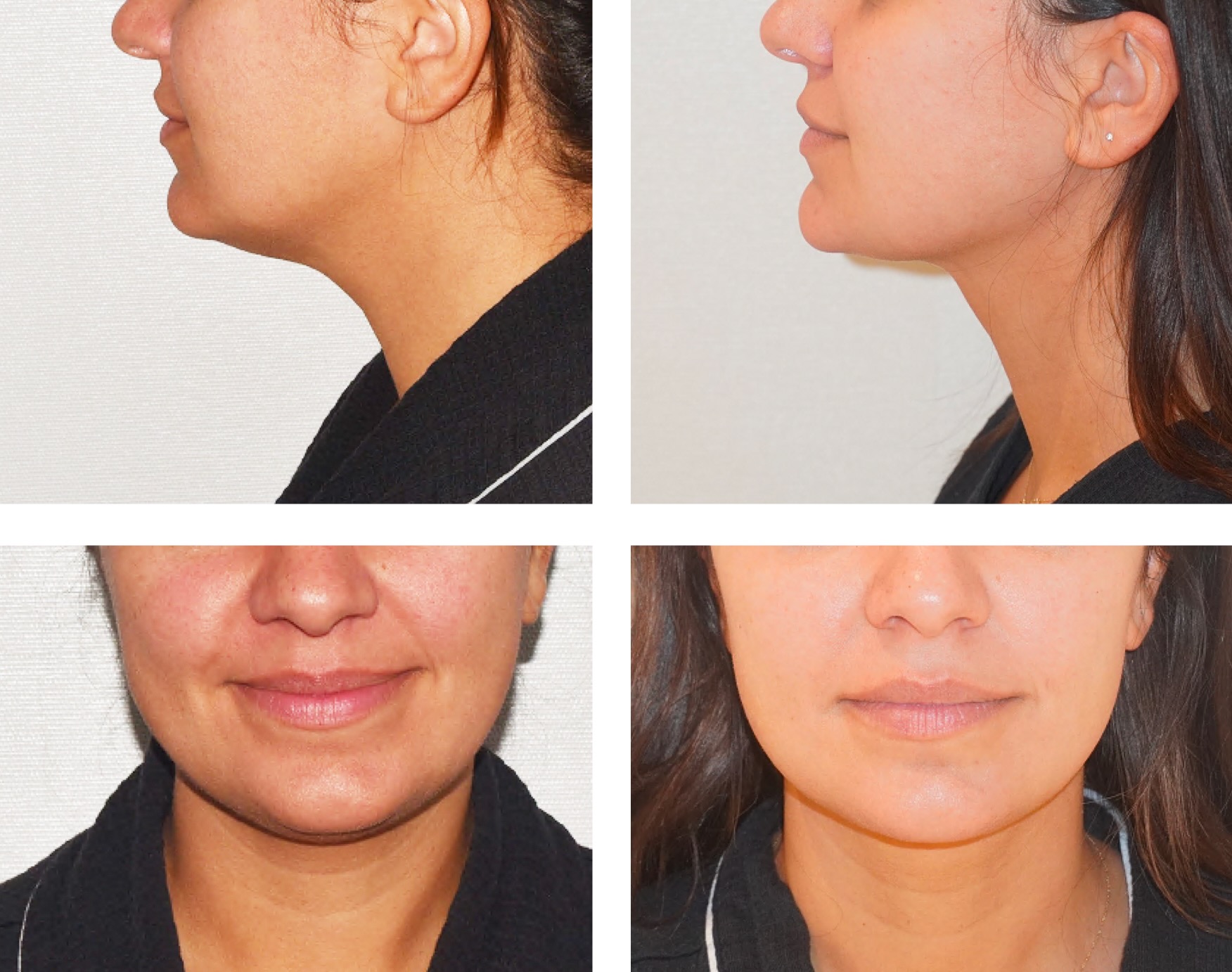 Before and After photos show side and front views of a woman's face and neck, highlighting the reduced fullness under the chin following chin liposuction.
