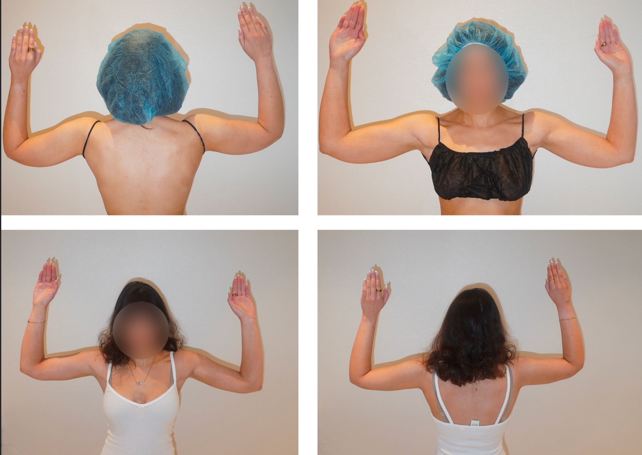 Four comparison photos in this Photo Gallery show two women from behind, arms raised, before and after Arm Liposuction; faces are blurred for privacy, and clothing and hairnets vary between images.
