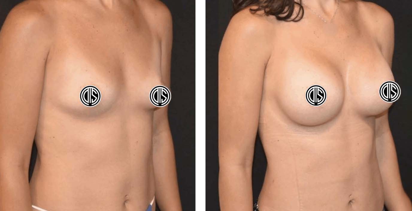 A side-by-side comparison of a person's torso showcases the transformative results achieved through breast augmentation surgery, embodying the essence of Before and After Photos often seen in Plastic Surgery journeys.