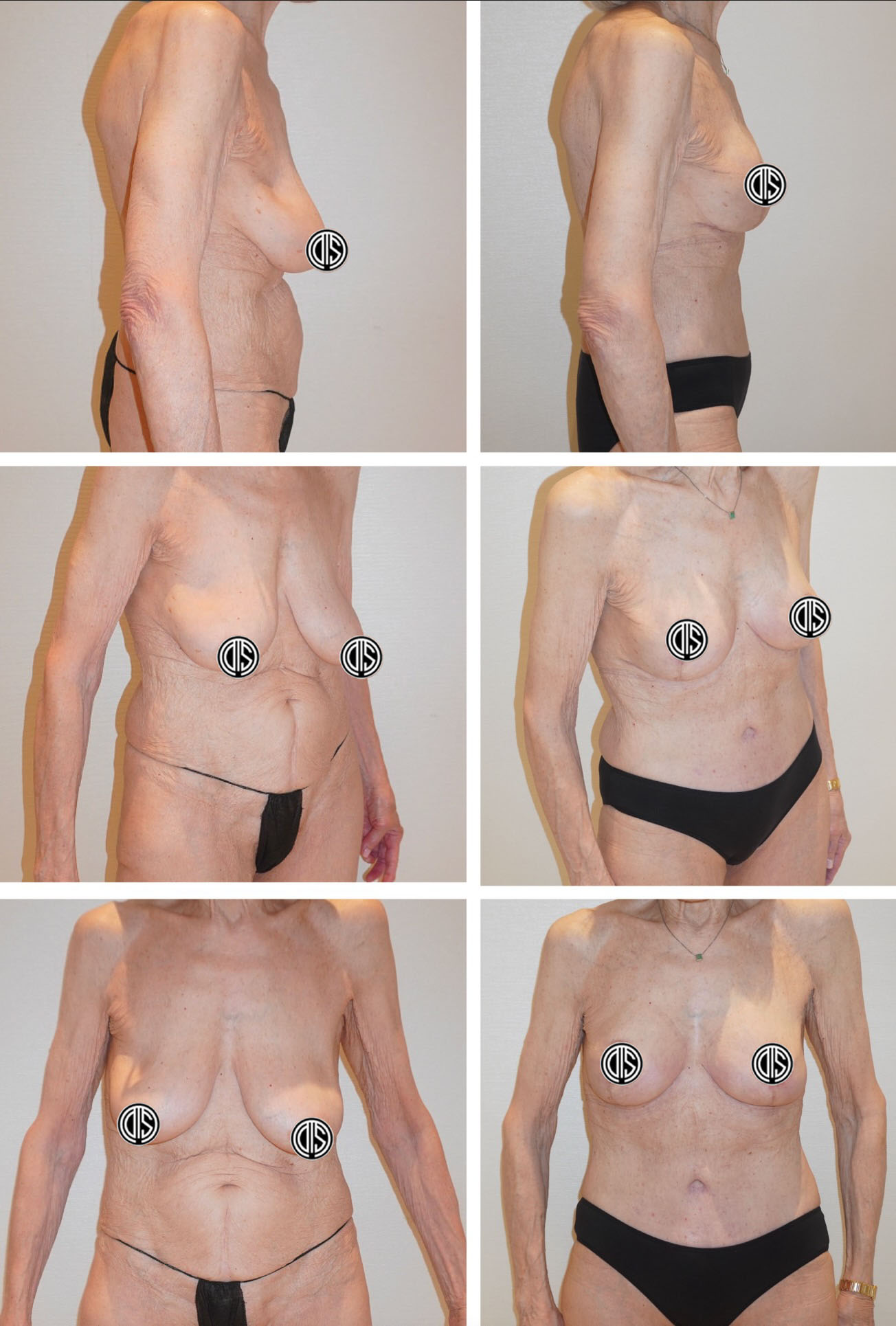 A collage of a woman's body showcasing Mommy Makeover photos.