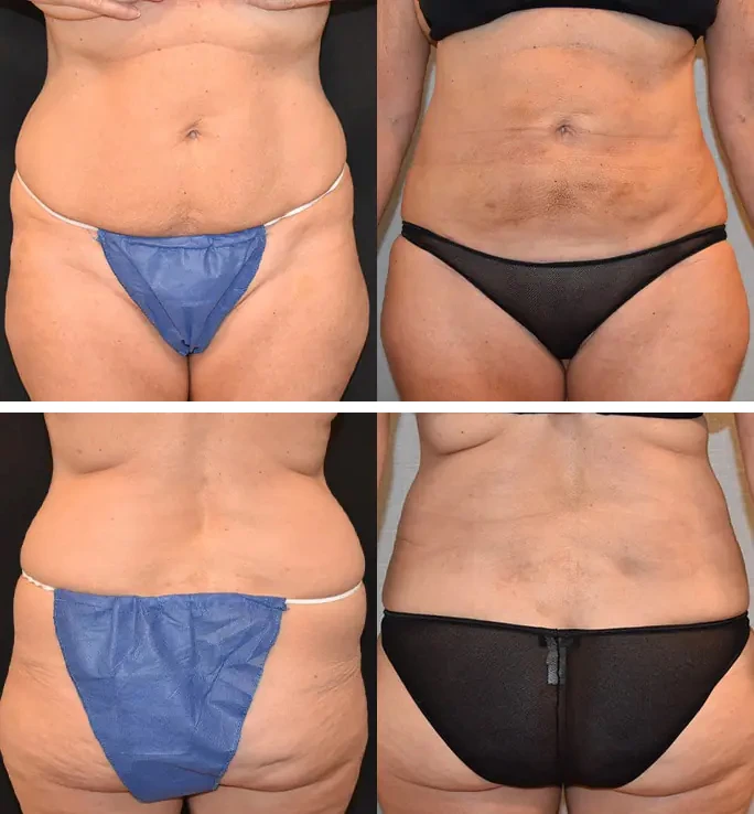 Bodytite tummy tuck before and after photos.