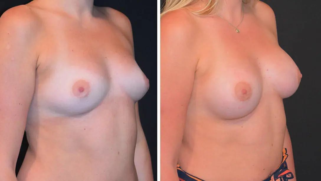 Explore the transformative results of breast augmentation through stunning before and after images.