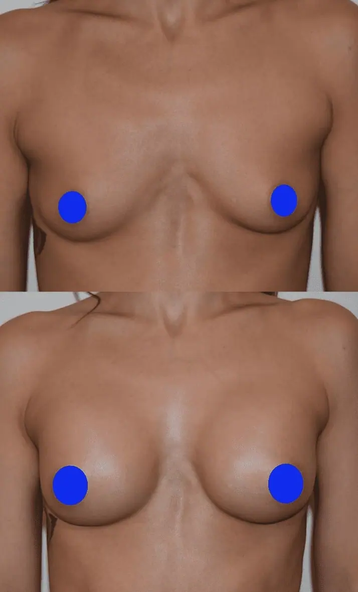 A woman showcasing breast augmentation before and after images with blue dots on her breasts.
