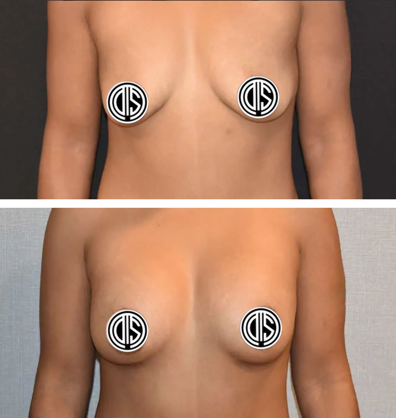 Two side-by-side images show a woman's torso before and after breast augmentation surgery, with logos covering the nipples for modesty.