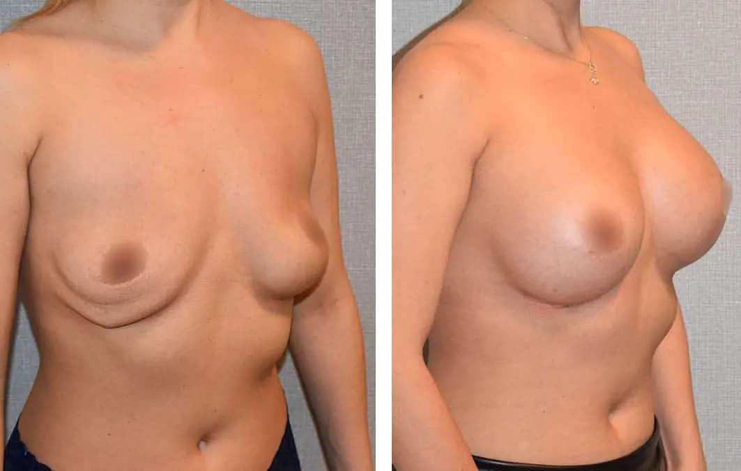 Breast Augmentation Before and After Images showcasing changes to a woman's breasts following surgery.