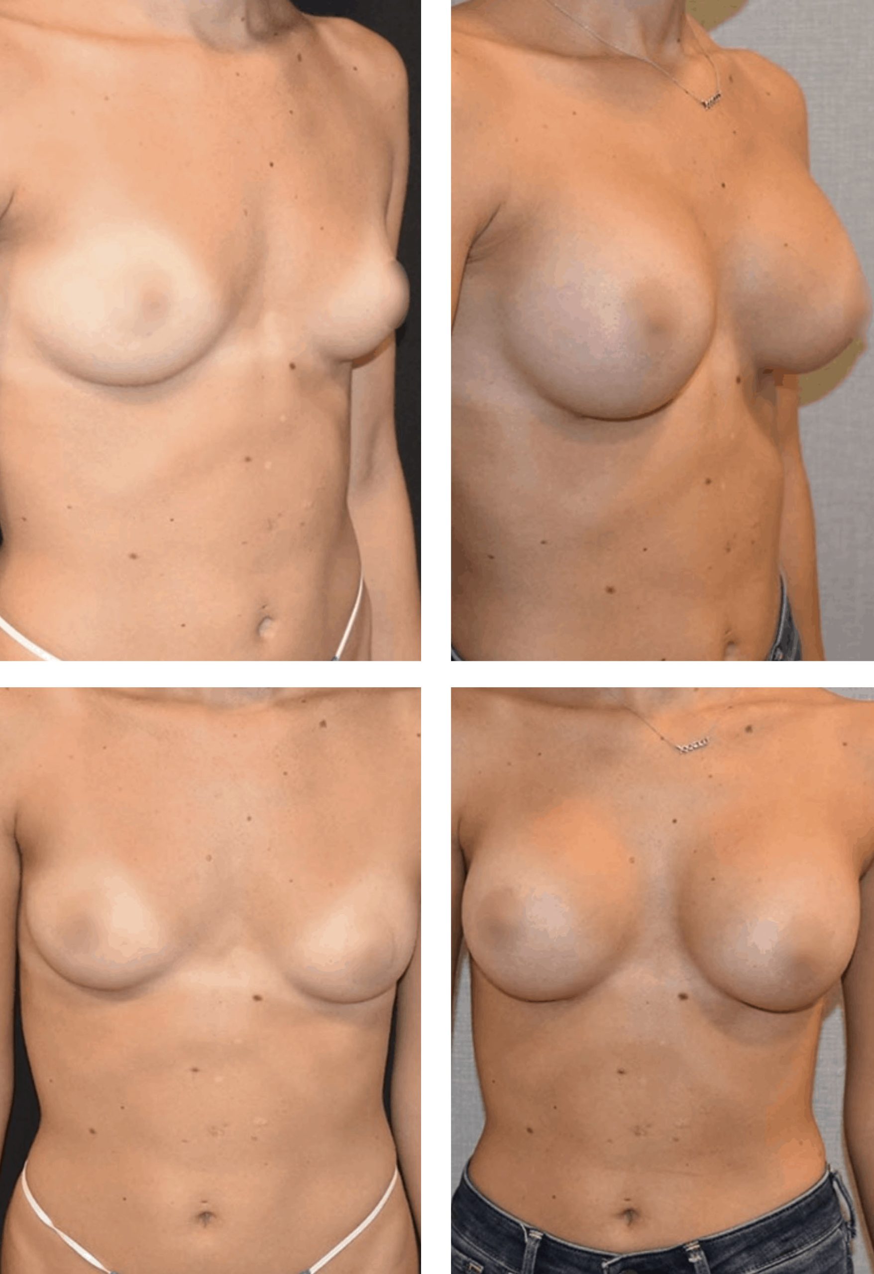 Two side-by-side before and after images display a person’s chest, highlighting the results of breast augmentation surgery.