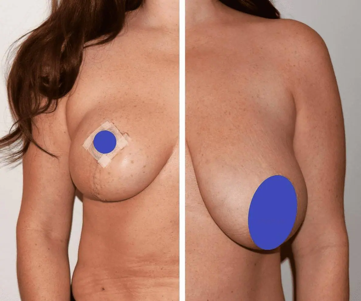 Breast Reduction Before and After Photos