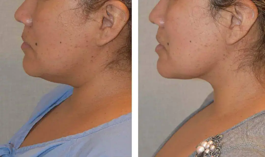 A woman's chin before and after liposuction.