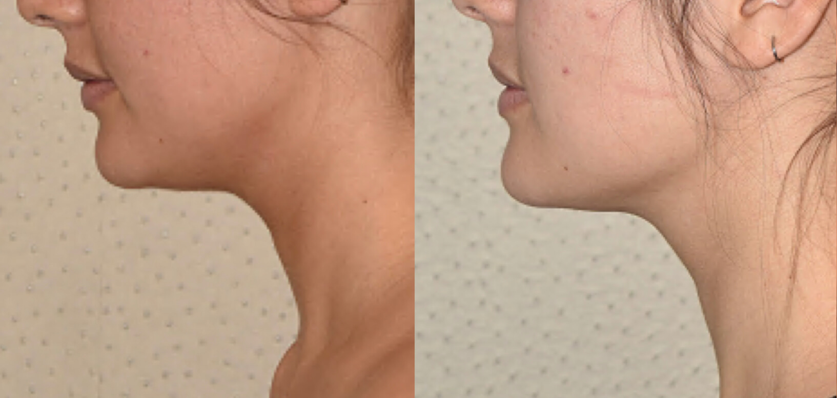 A woman's chin before and after liposuction.