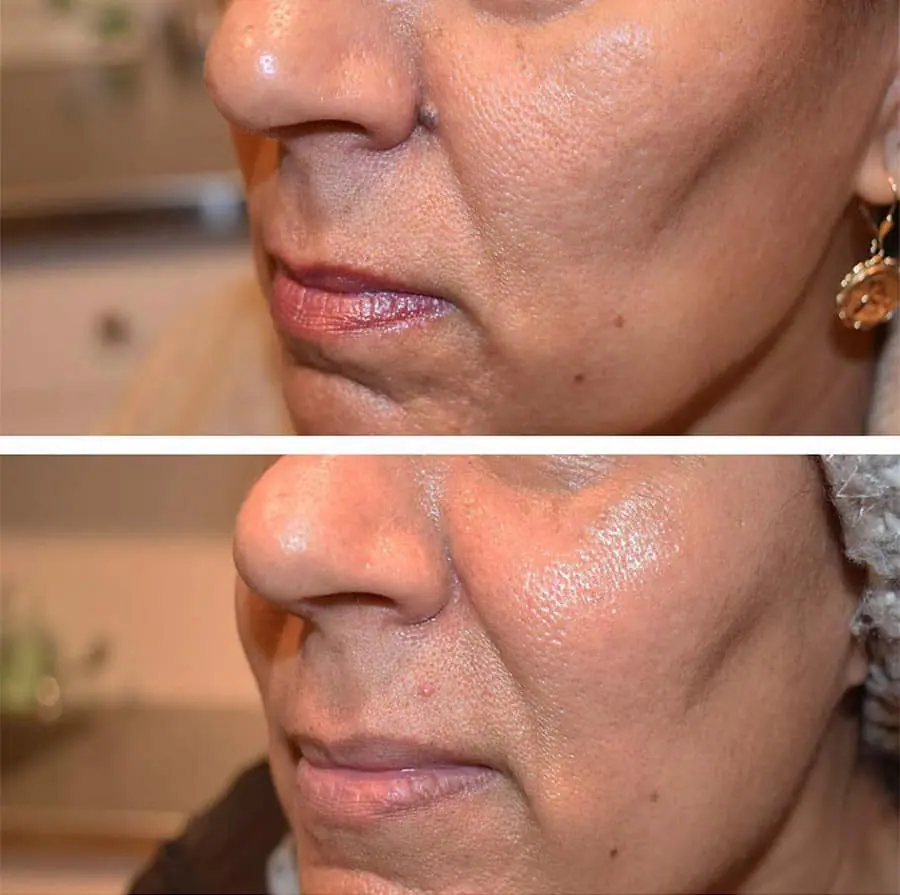 Before and after photos of a woman with facial trauma and wrinkles.