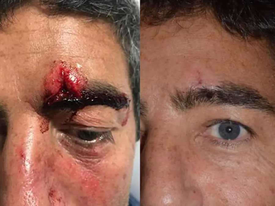 Two pictures of a man with facial trauma, featuring blood on his face.