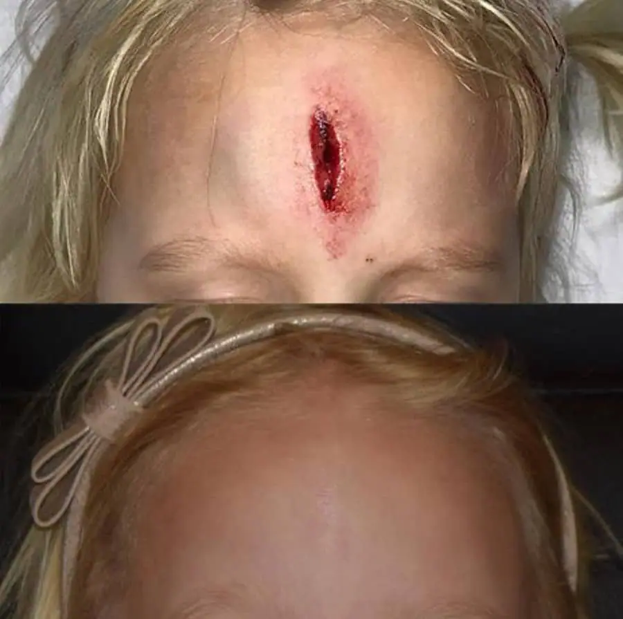 Two pictures of a little girl showing facial trauma and reconstruction before and after.