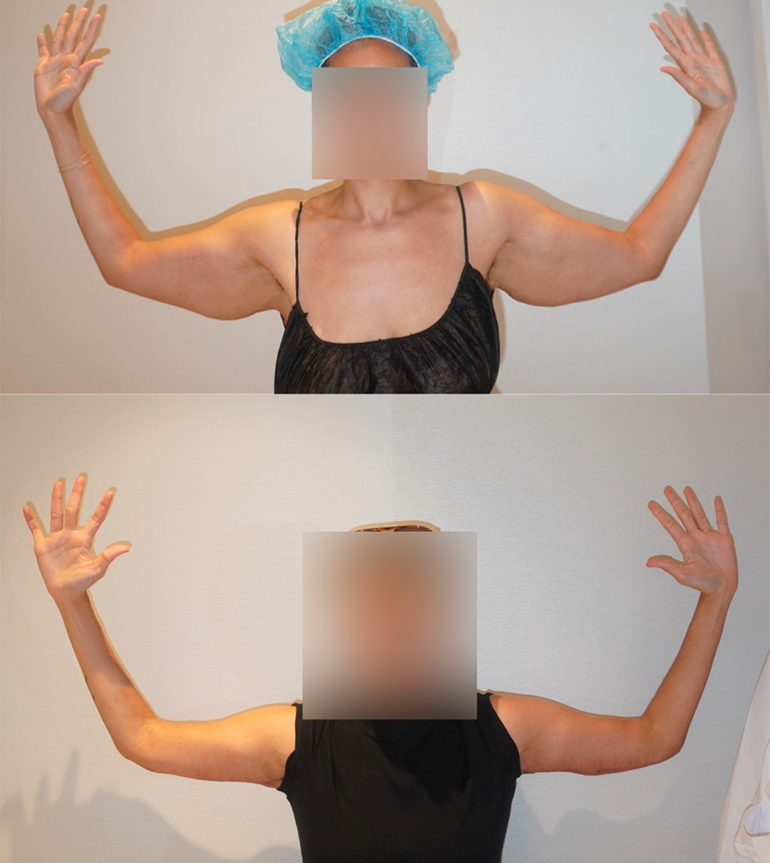 Two side-by-side Arm Lift photos show a person raising both arms, highlighting the change in arm shape before (top) and after (bottom) the procedure. Face is blurred for privacy.