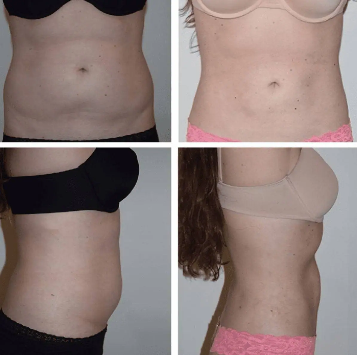 Tummy tuck and liposuction before and after.