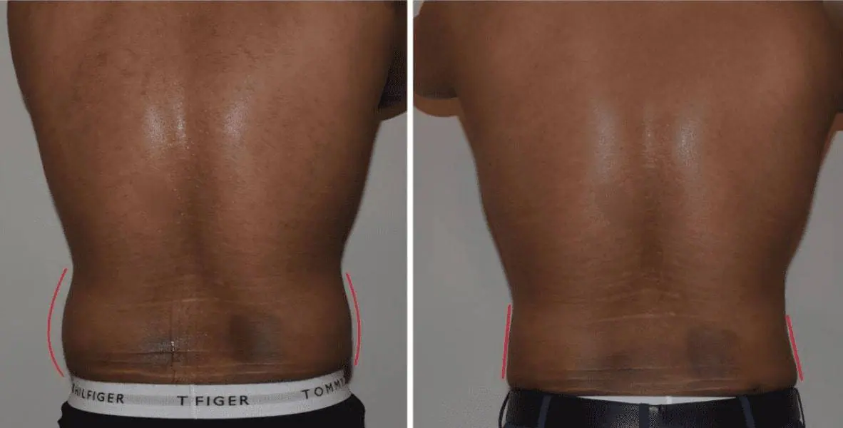 Tummy tuck and liposuction before and after.