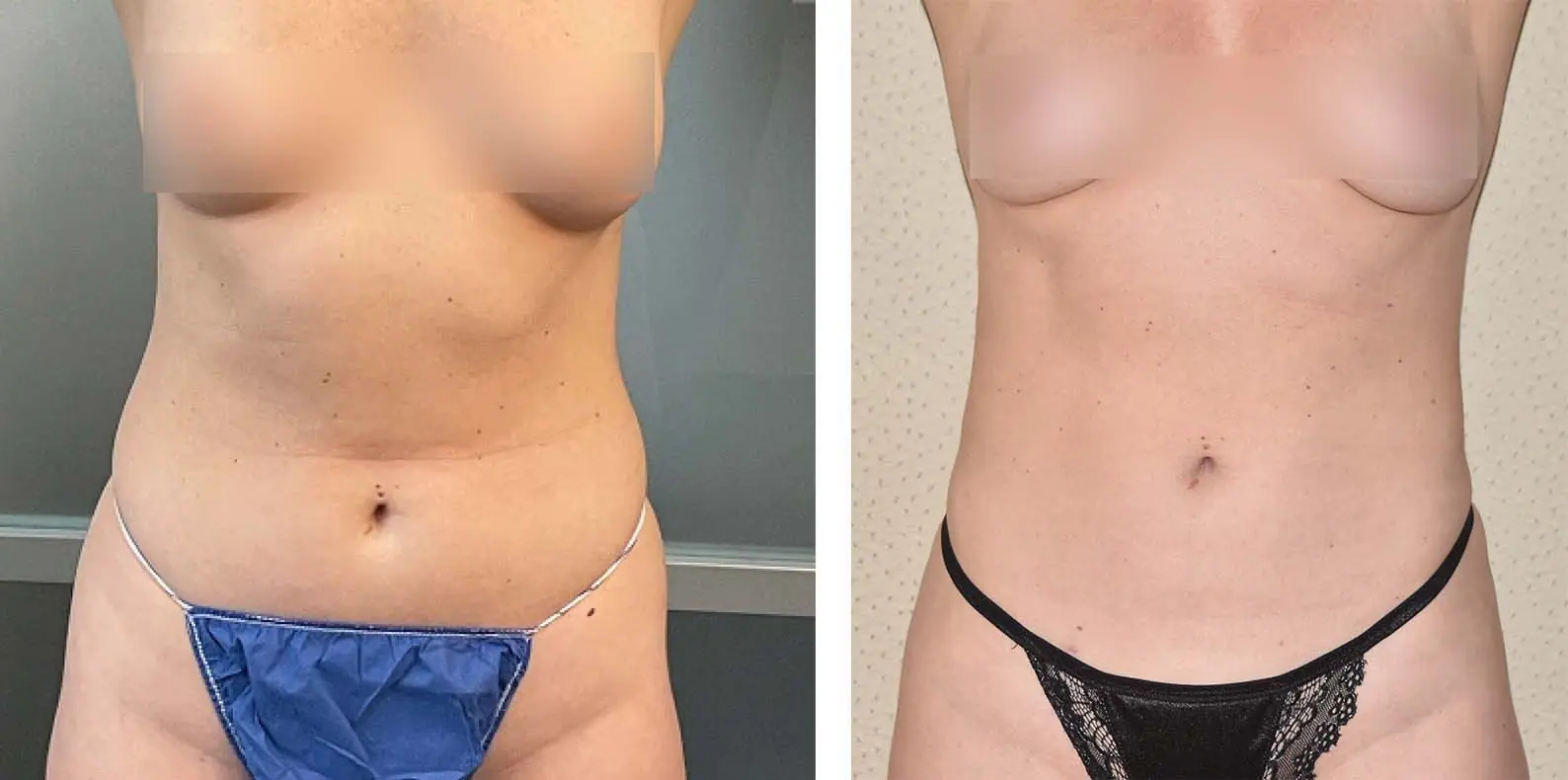 Liposuction before and after photos showcasing the transformation achieved with a tummy tuck.