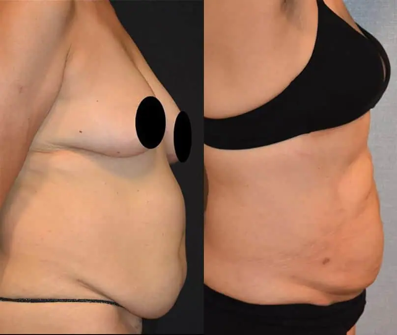 Liposuction before and after tummy tuck.