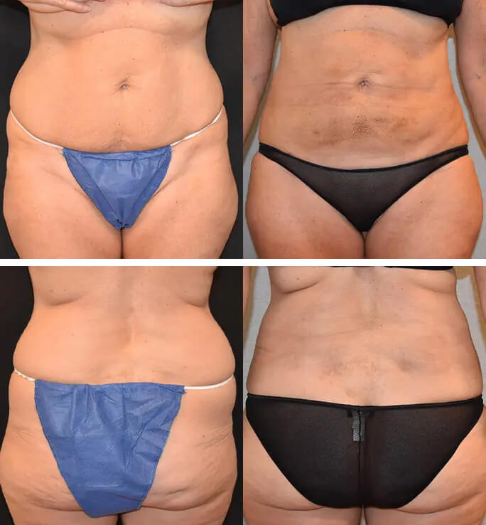 Tummy tuck and liposuction before and after.
