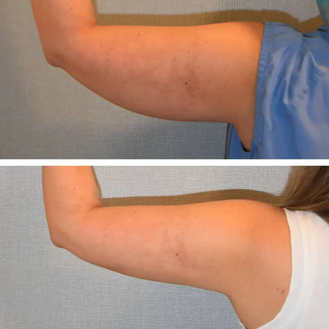 Liposuction before and after pictures of a woman's arm.
