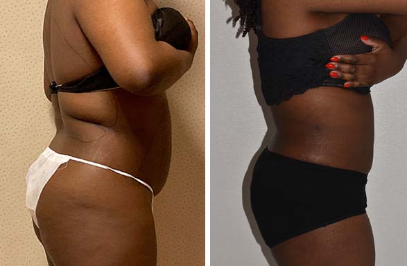 Before and after photos of a woman's tummy tuck and liposuction transformation.