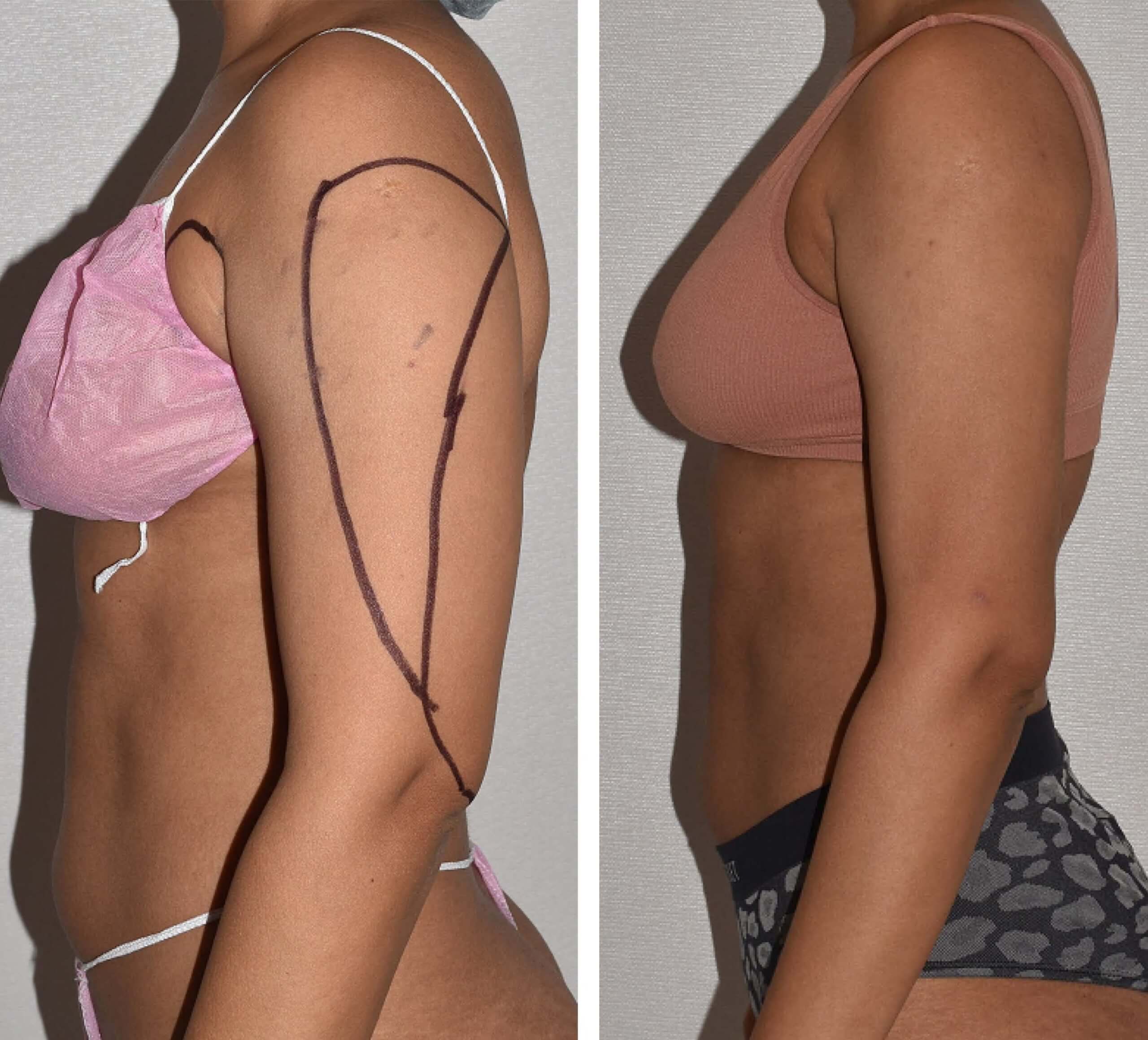 Tummy tuck and liposuction before and after.