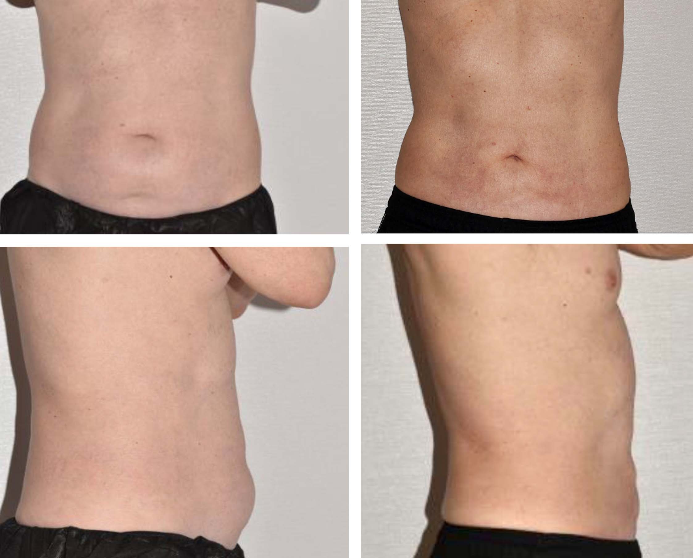 Liposuction before and after, including tummy tuck.