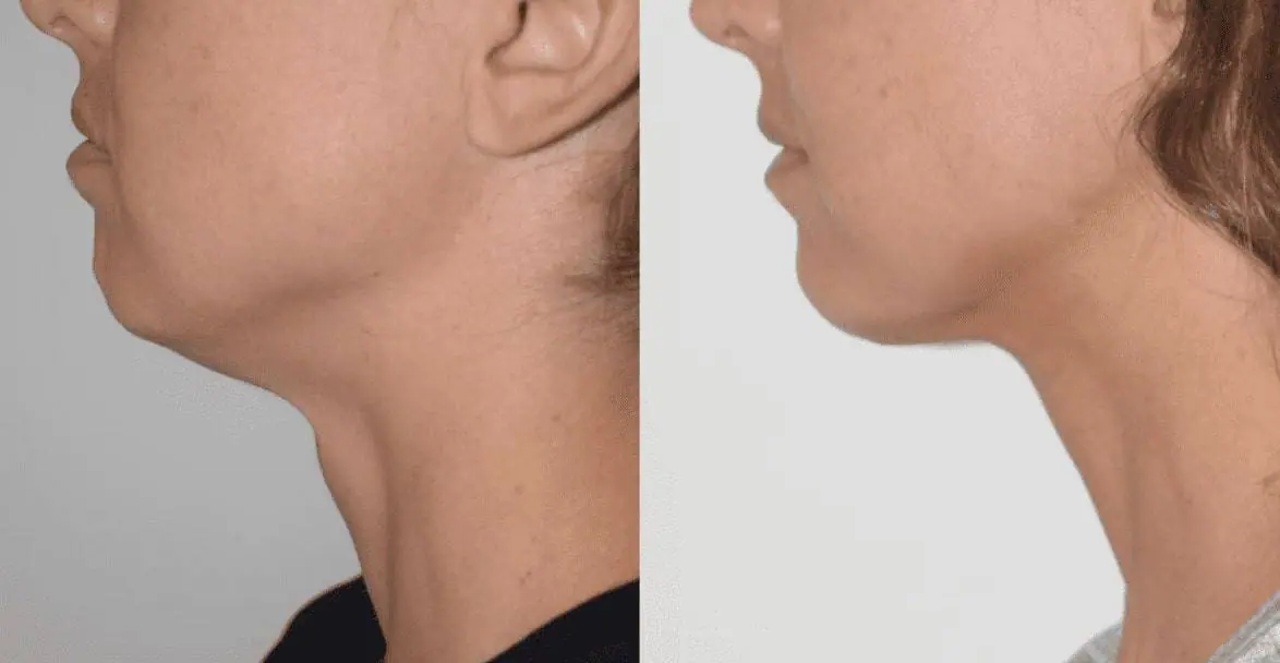 A woman's neck before and after undergoing liposuction.