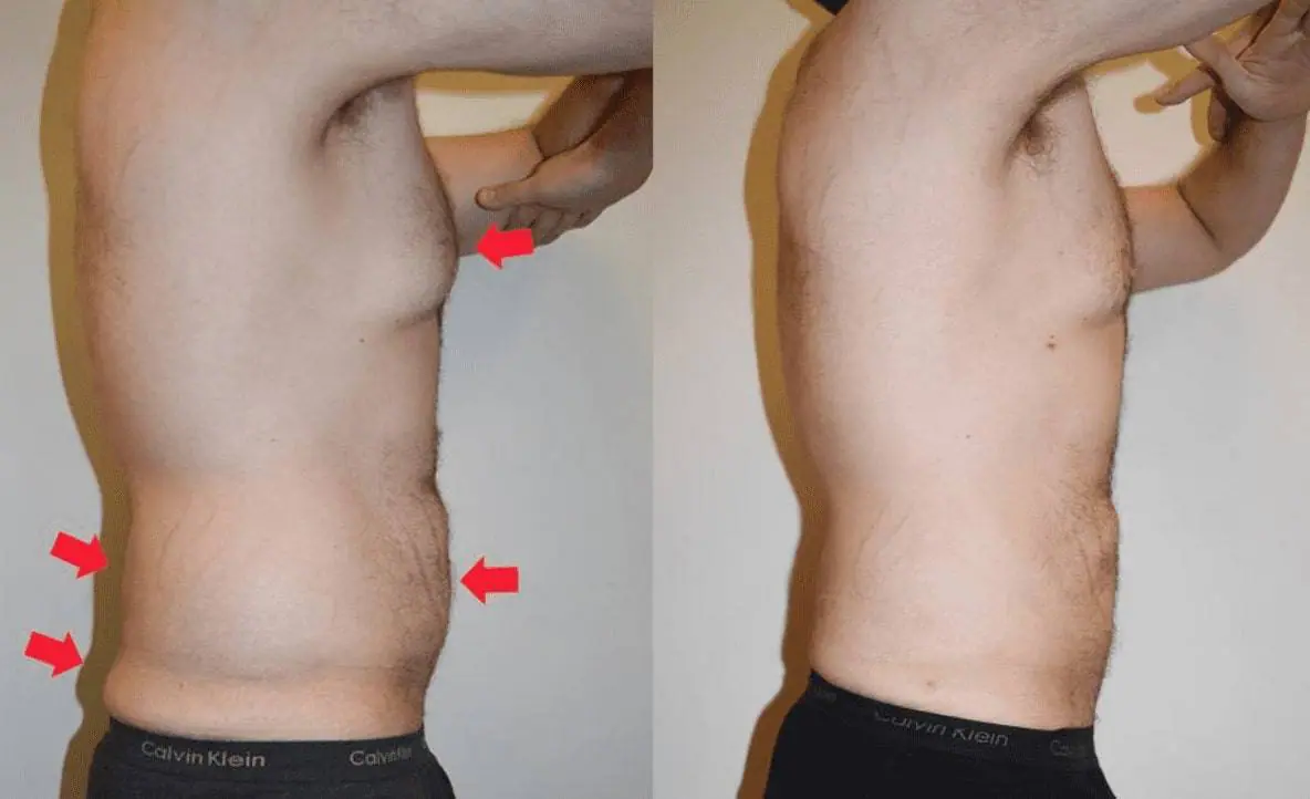 Liposuction before and after pictures of a man's tummy tuck.