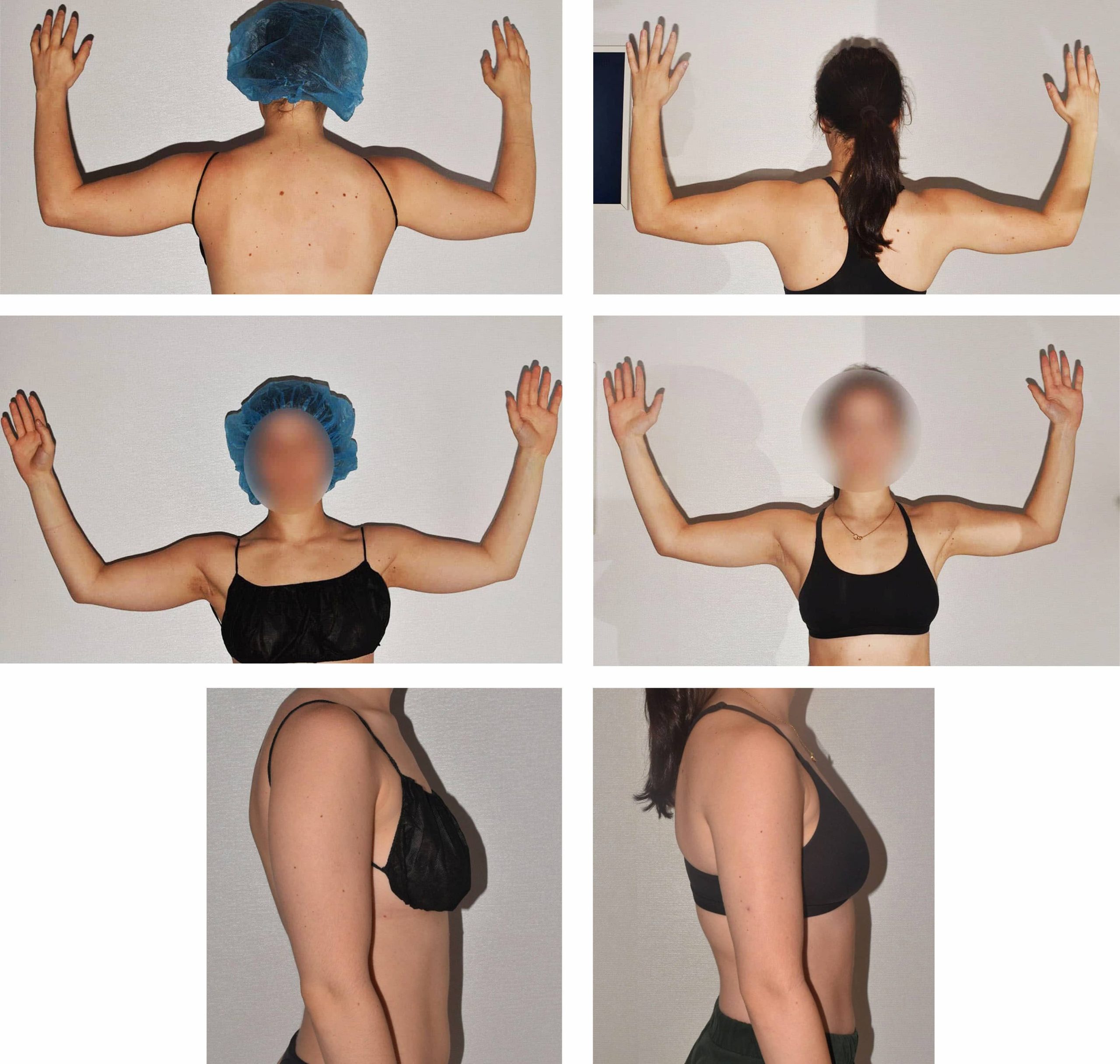 Six photos in this before and after photo gallery show a woman from the back and side with arms raised. Two rows highlight outcomes likely from arm liposuction, with faces blurred for privacy.