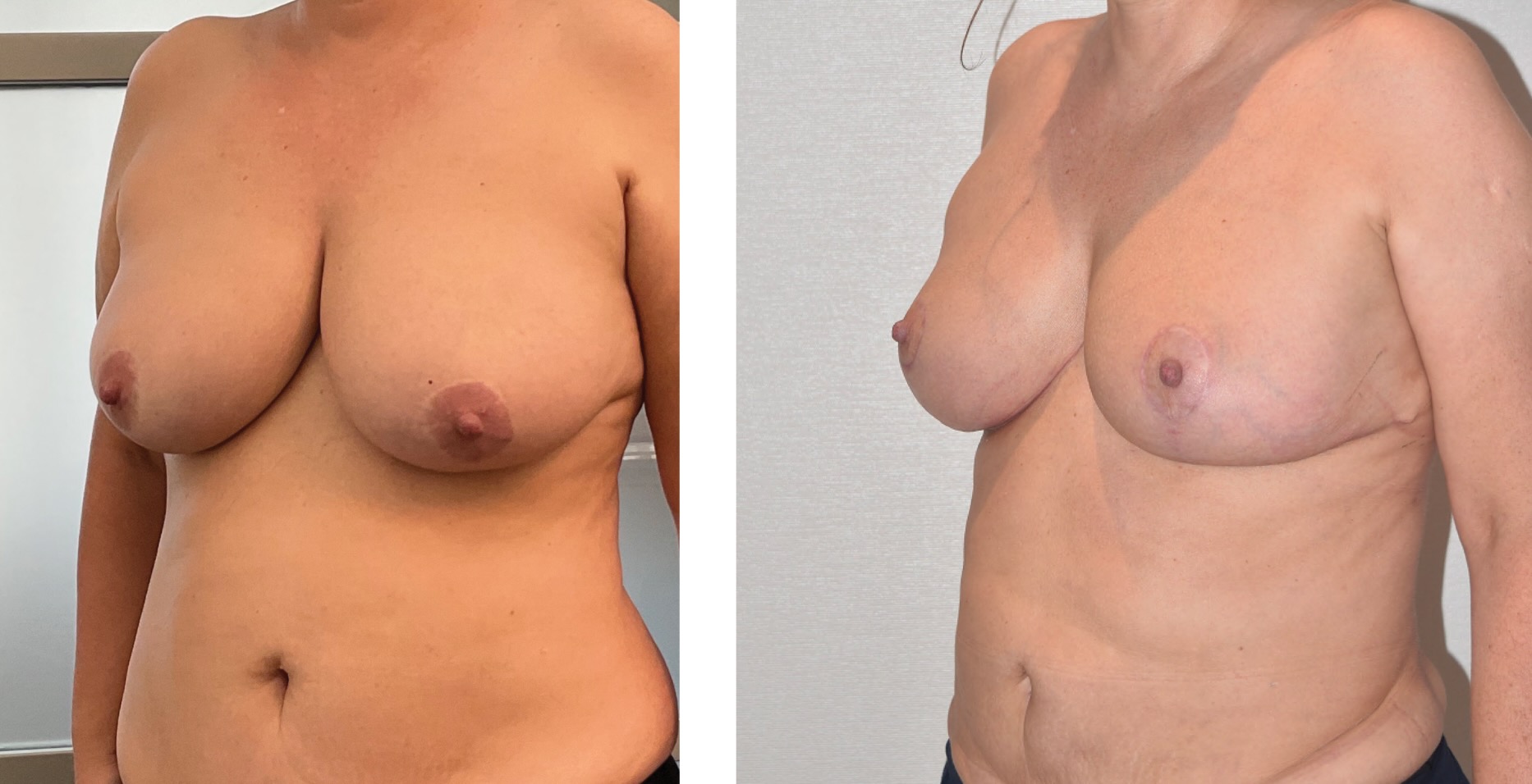 Two side-by-side Breast Lift Photos show a woman's torso before and after surgery, highlighting visible differences in breast shape and size.