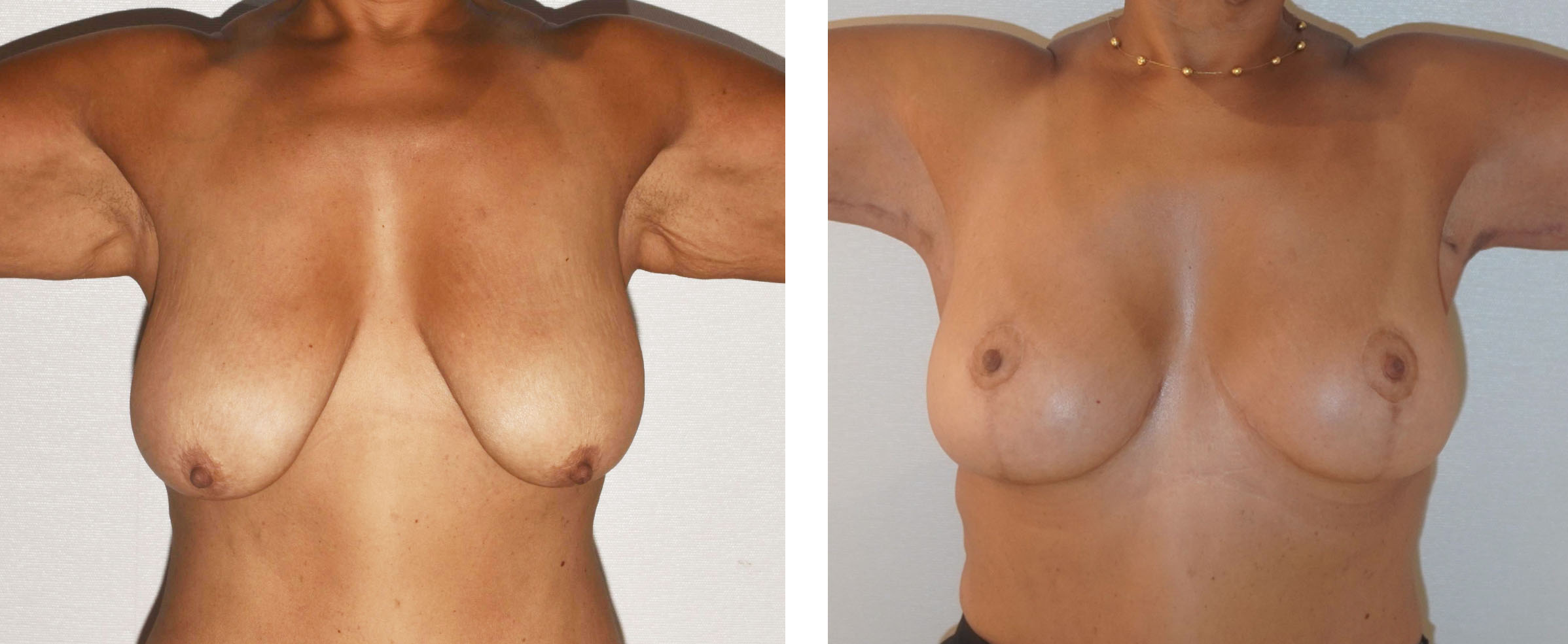 Side-by-side comparison of a woman's torso in Breast Lift Before and After Photos, highlighting changes in breast size and shape with arms raised.