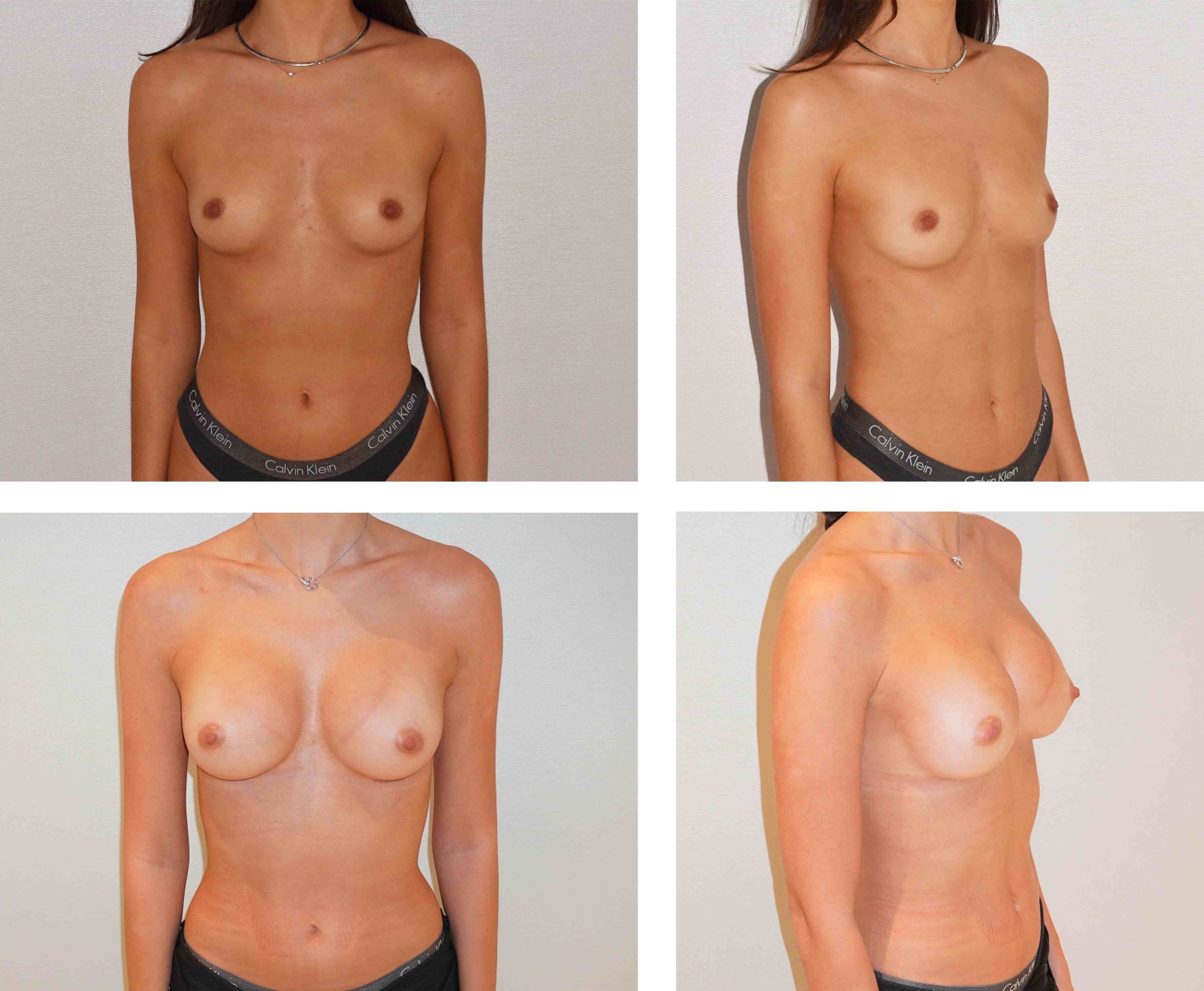Before and after images of a woman showcase the results of breast augmentation surgery, featuring both front and side angles.
