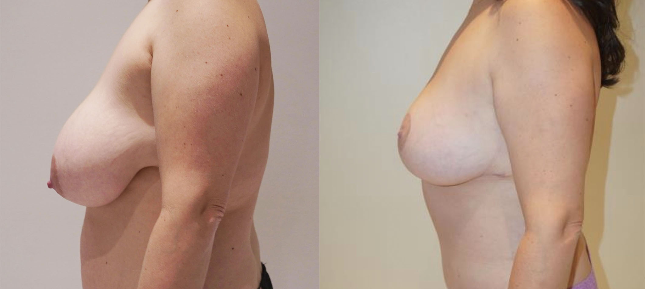 A comparison of a woman's breast using Breast Lift Photos showcases the transformation achieved through a Breast Lift, highlighting results with clear before and after photos.