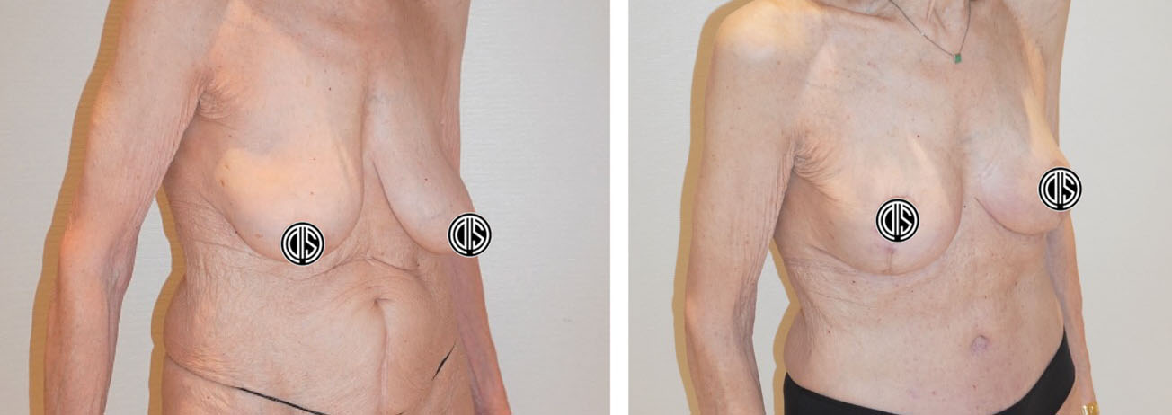 Two side-by-side before and after photos display an elderly woman’s torso following breast reconstruction surgery, with the breasts and nipples discreetly covered for privacy.