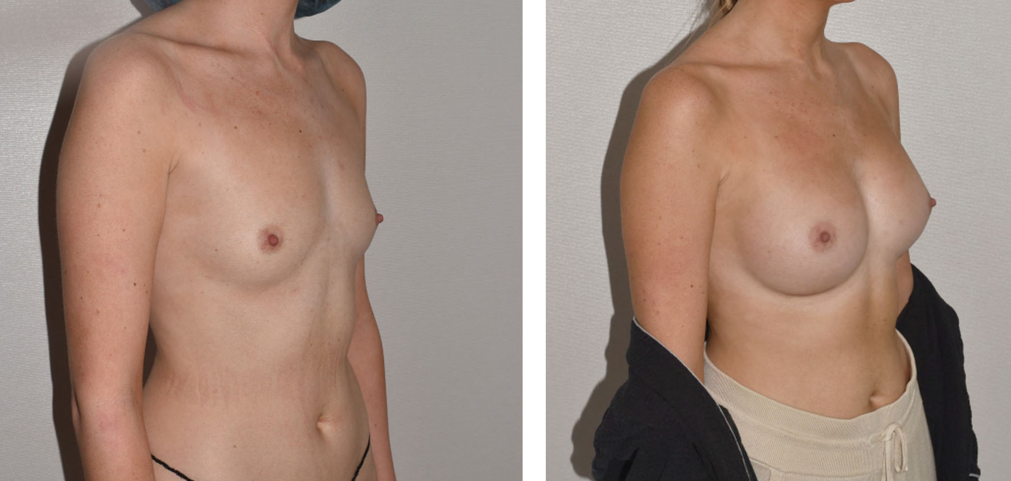 Side-by-side Breast Augmentation before and after images highlight a woman’s torso, clearly showing increased breast size in the after photo.