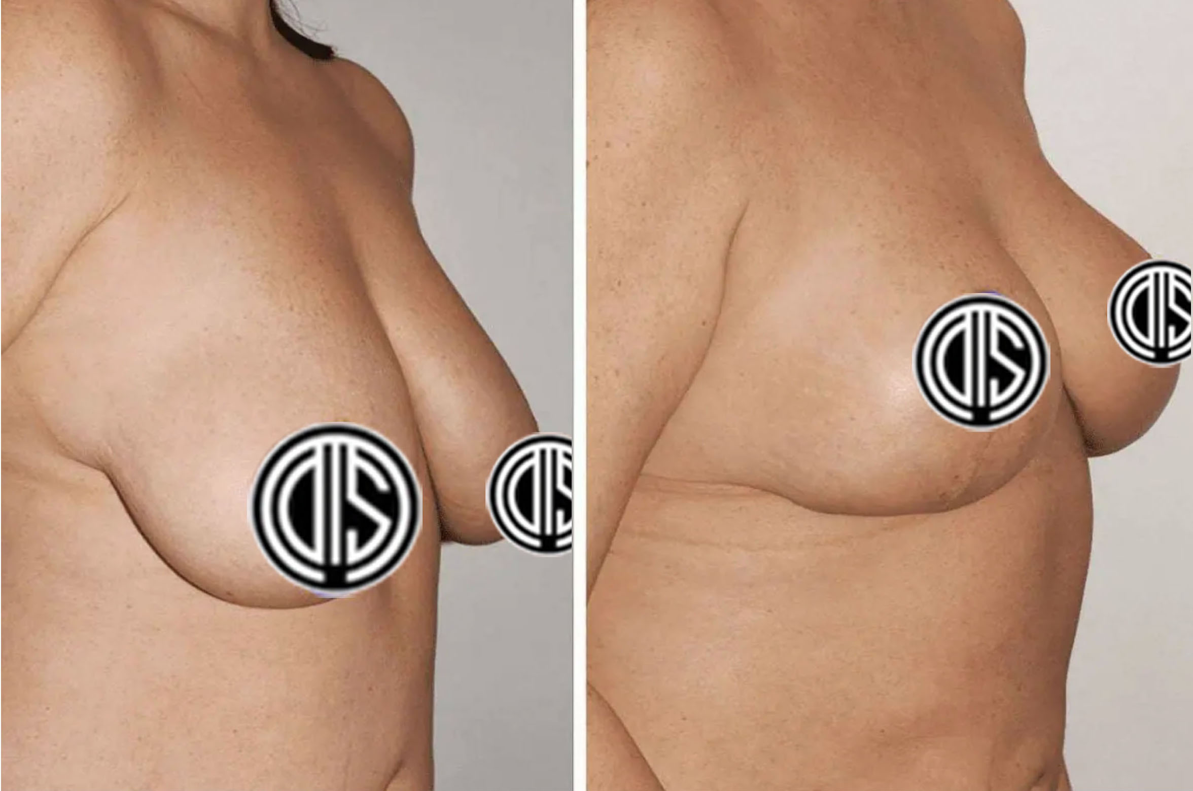 Side-by-side Breast Lift Photos display a woman's chest before and after surgery, illustrating increased firmness and elevation in the after image. Censored circles cover the nipples for privacy.
