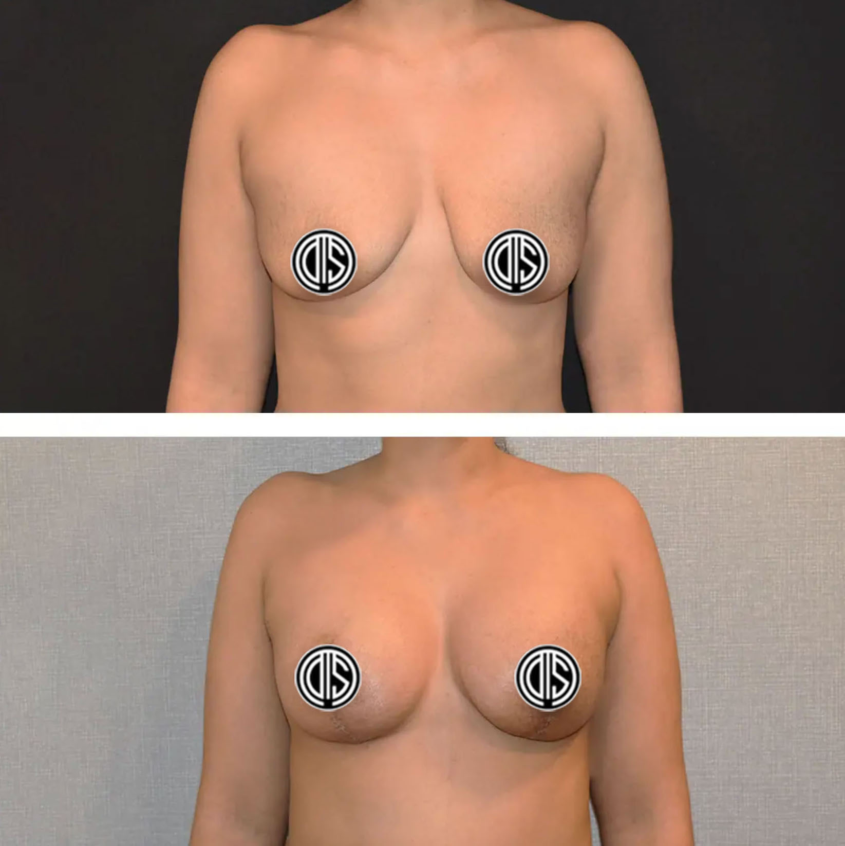 Two side-by-side images show a woman's torso in Before and After Photos of breast augmentation surgery, with the nipples covered by circular logos.