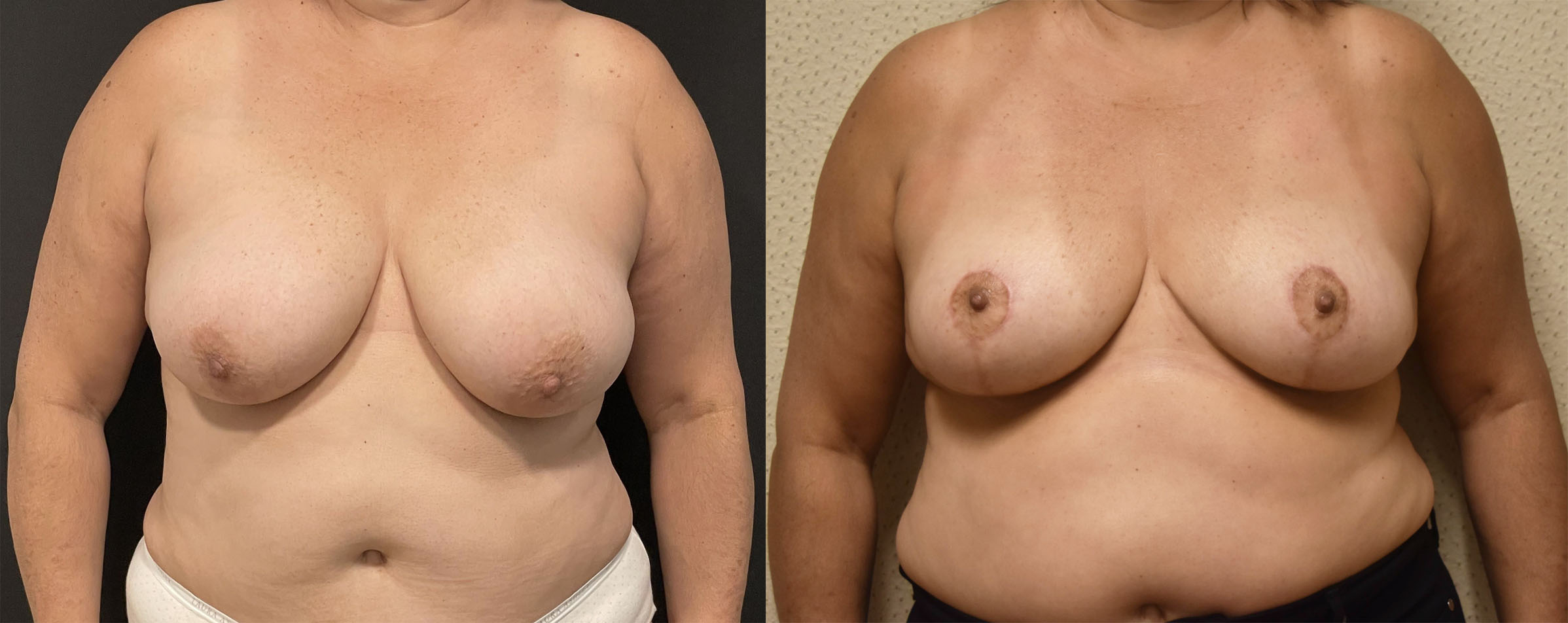 Two side-by-side before and after photos show a woman's torso prior to and following breast reduction surgery, highlighting noticeable breast lift results in both size and shape.