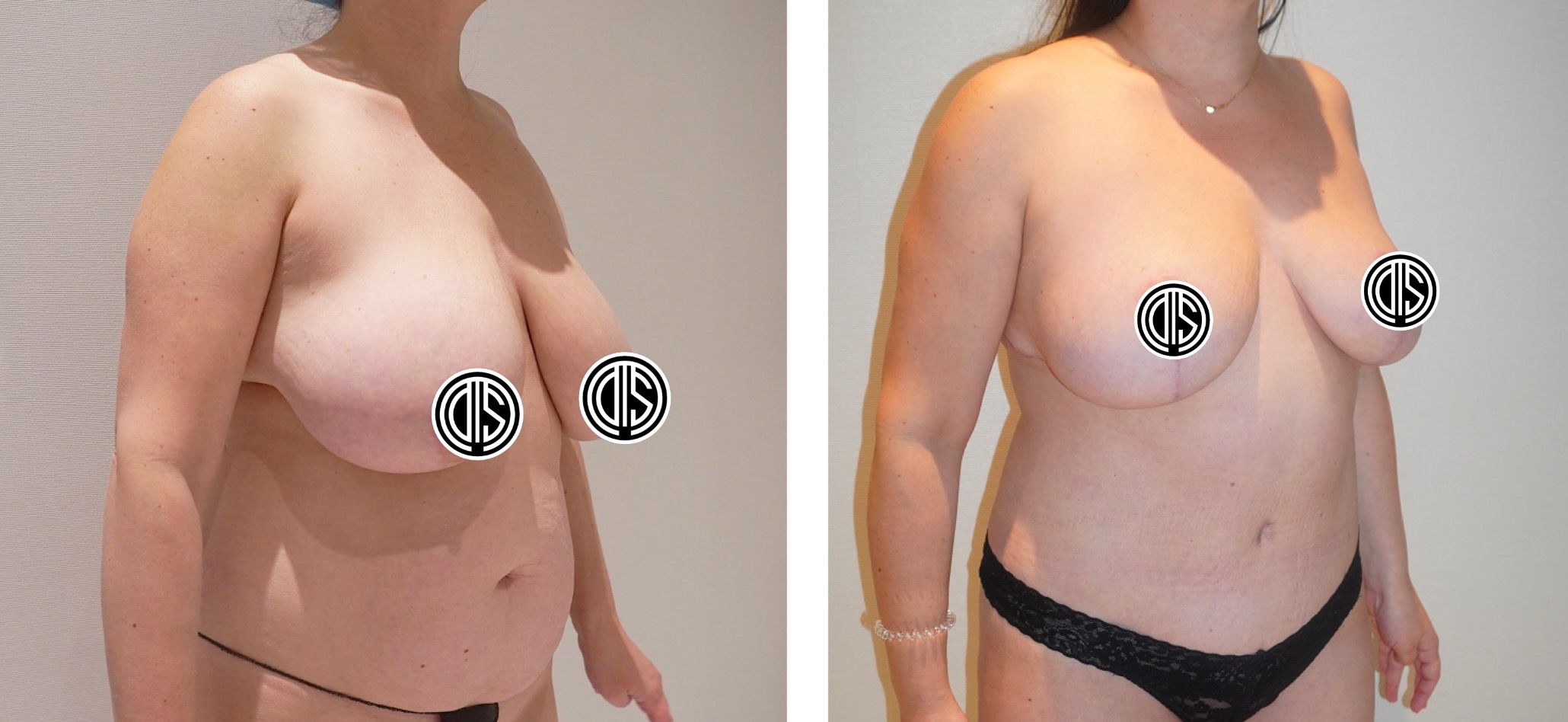 Side-by-side before and after photos show a woman’s transformation following breast reduction surgery, highlighting the decrease in breast size and improved body contour often seen in breast lift photos.