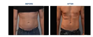 Tummy tuck before and after with Emsculpt Neo.