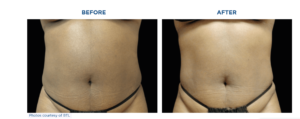 A woman's abdomen before and after undergoing Emsculpt Neo treatment for liposuction.