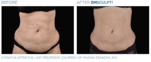 Enhance your appearance with remarkable tummy tuck before and after transformations using the innovative Emsculpt Neo.