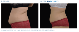 Witness the remarkable transformation of a tummy tuck before and after with the innovative Emsculpt Neo technology. Experience the incredible results achieved by this groundbreaking procedure in sculpting and toning