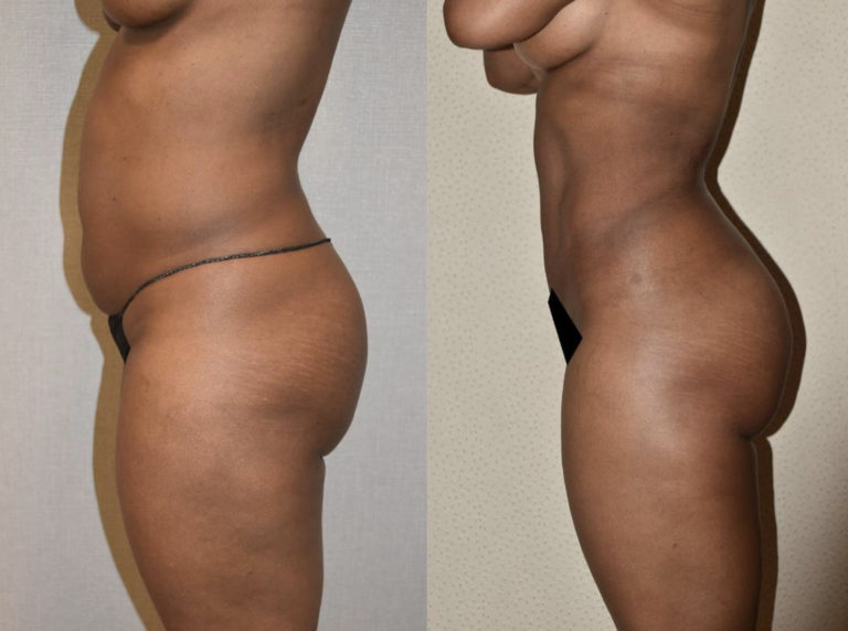 Lipo 360 - See amazing tummy tuck before and after transformation!