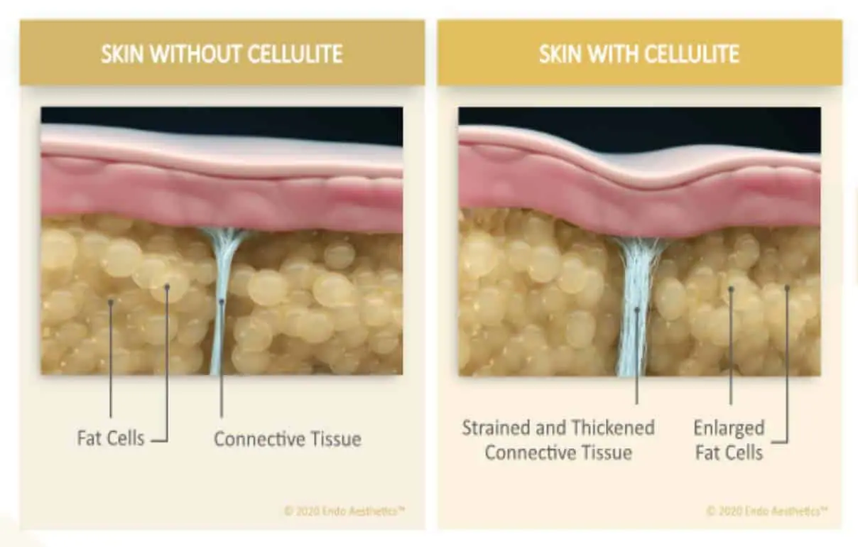 Improve the appearance of skin with cellulite using QWO treatment.